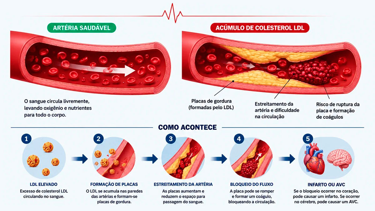 Infográfico comparando uma artéria saudável a uma com acúmulo de colesterol LDL. Na parte inferior, um fluxo em 5 etapas ilustra desde o excesso de LDL e formação de placas de gordura até o bloqueio do sangue que causa infarto ou AVC.