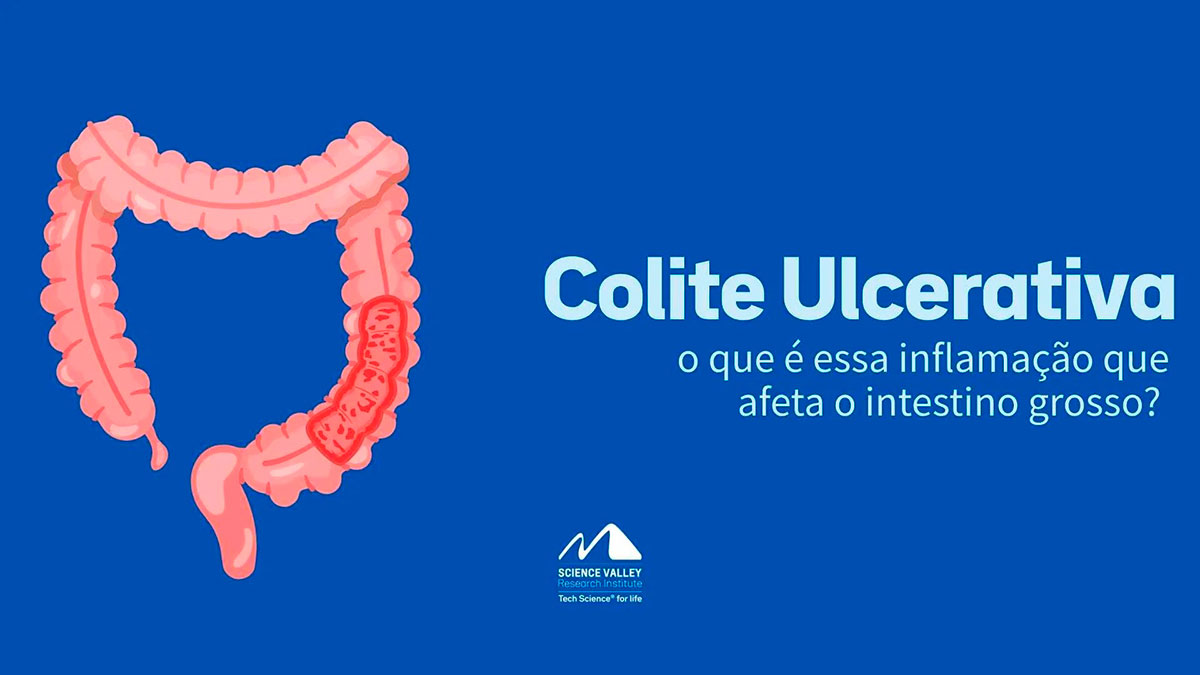 Colite Ulcerativa: o que é essa inflamação que afeta o intestino grosso?