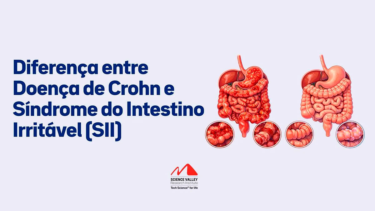Diferença entre Doença de Crohn e Síndrome do Intestino Irritável (SII)